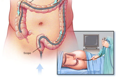 Março  Azul | Câncer Colorretal | Março Azul alerta para aumento do câncer colorretal entre jovens
