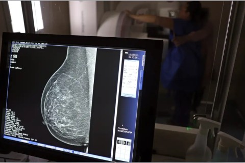 Saúde | Diagnóstico precoce | Câncer de mama: mamografia deve ser feita a partir dos 40 anos, orienta Femama